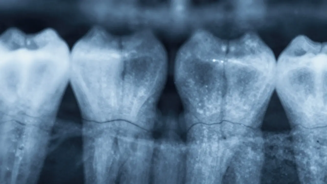 Jak vypadá mezizubní kaz? Příznaky, rizika a co s tím