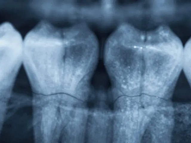 Jak vypadá mezizubní kaz? Příznaky, rizika a co s tím