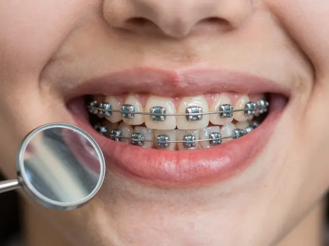 Zničené zuby po rovnátkách: Jak předcházet poškození a obnovit zuby po ortodontické léčbě