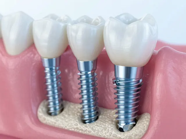 Jak se dává zubní implantát: Podrobný průvodce pro pacienty